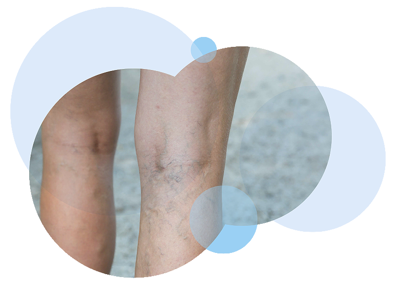 Varicose Veins 1