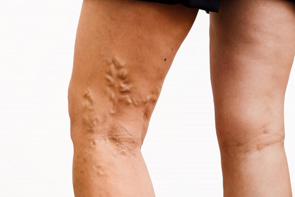 Varicose Vein Removal Clinic