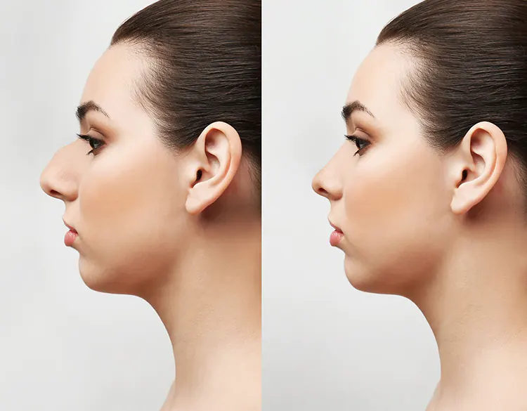 non-surgical-rhinoplasty-sydney-australia