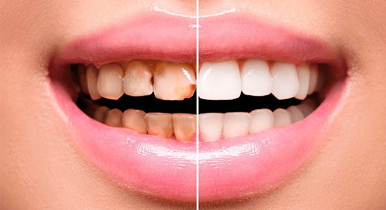Teeth Whitening Damage Teeth