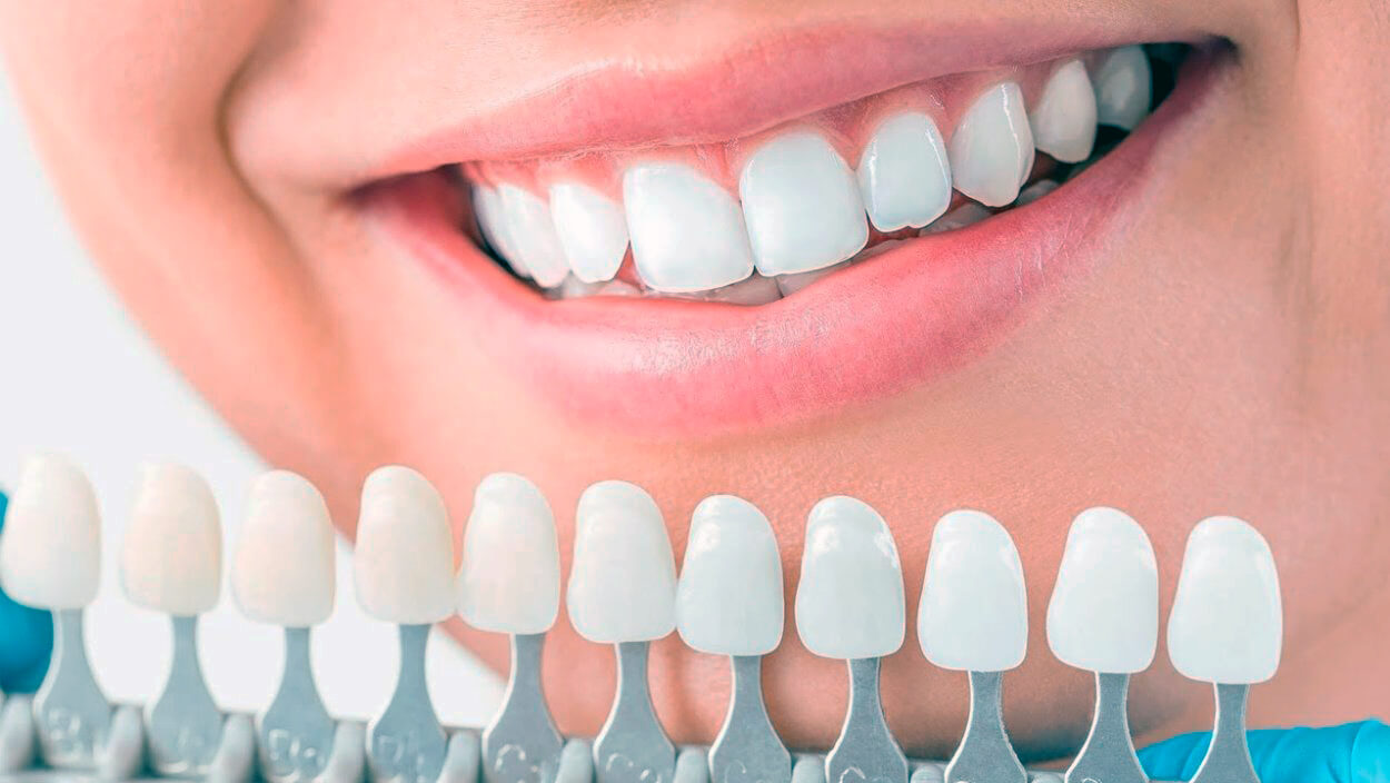 Dental Veneers