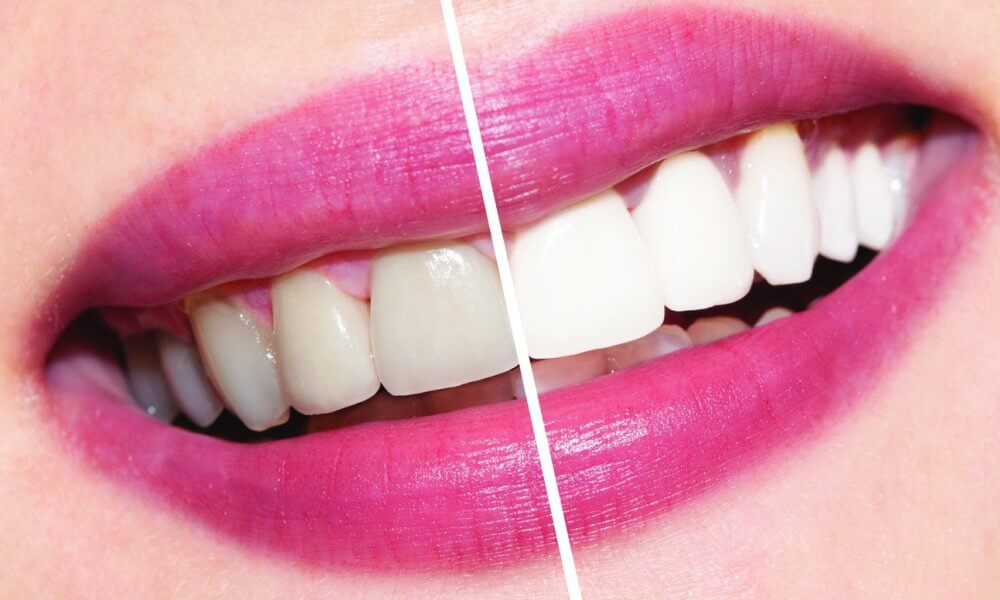 whiten teeth