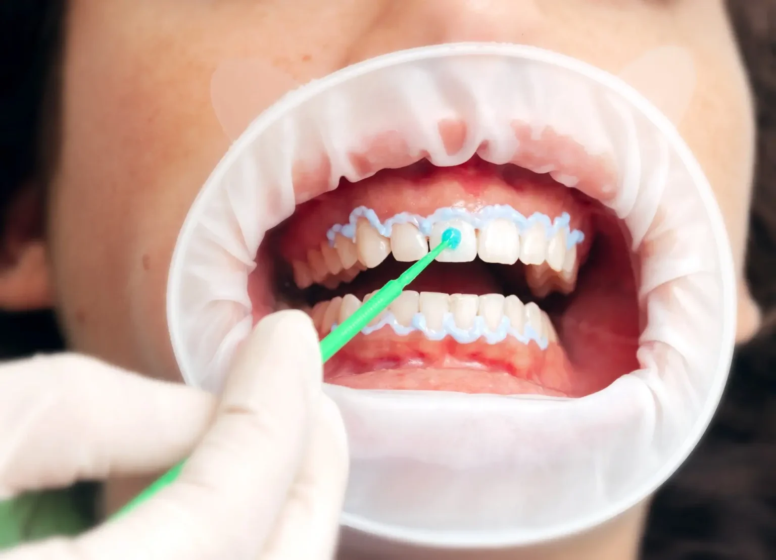 In-Chair-Whitening